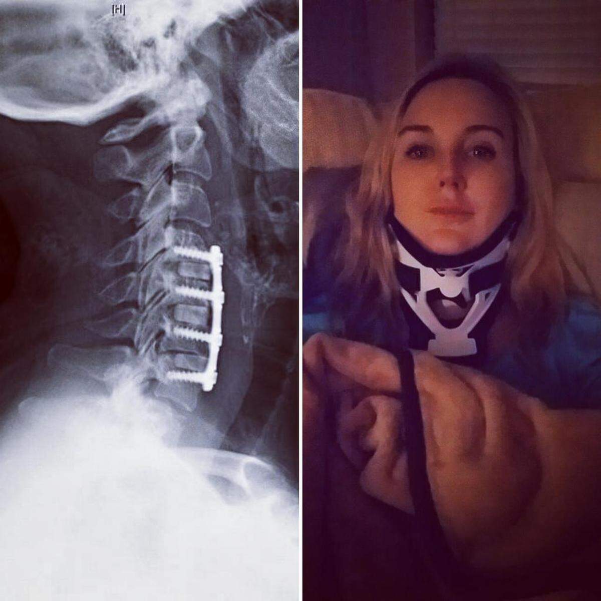 At left, an image taken post-surgery showing the titanium plate, screws and implants from the bone bank.