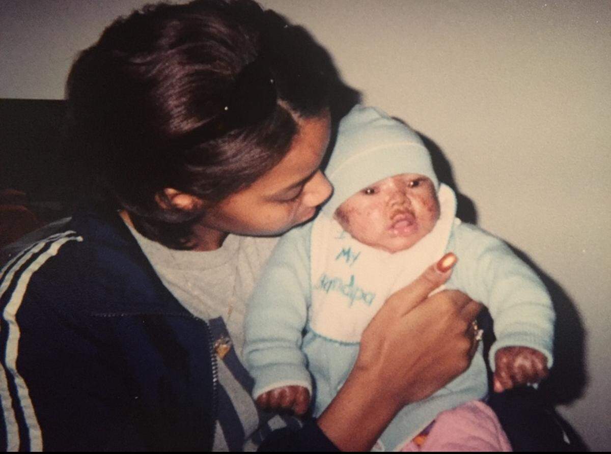 It took several months after she was born for Jeyźa Gary to receive a diagnosis of lamellar ichthyosis. 