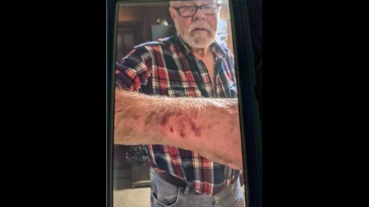 In this photo filed with his lawsuit in U.S. District Court, Jerry Baxter of Lincoln County, NC, shows an arm injury he says came at the hands of North Carolina troopers outside his rural home in 2018.