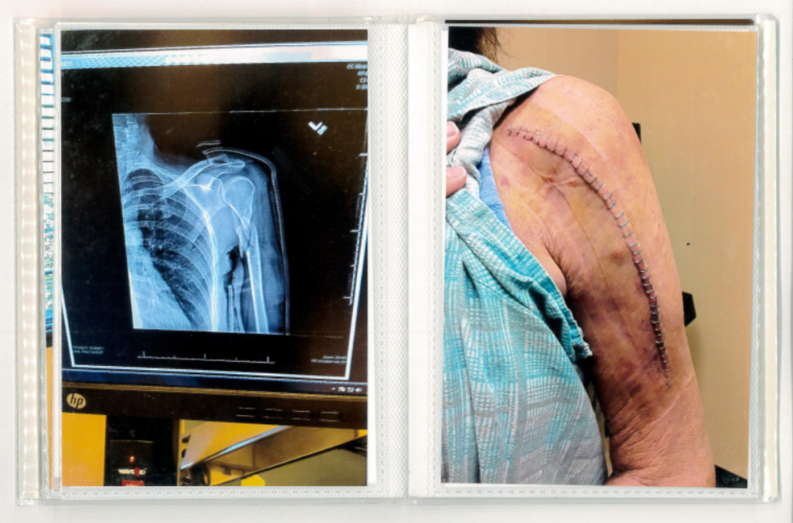 Cindy Gardner had to be operated on in 2020 when she claims a Mooresville police officer broke her shoulder when she wouldn’t show him identification at her home.