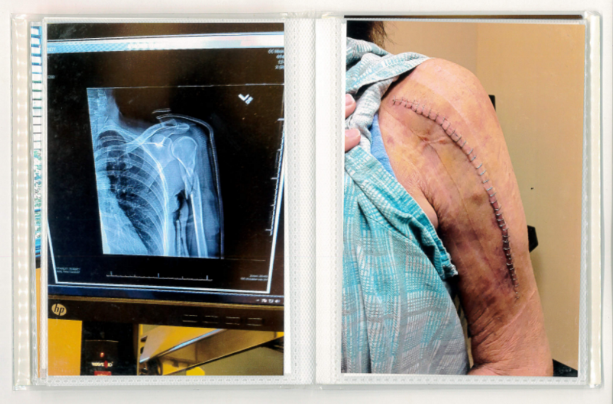 Cindy Gardner had to be operated on in 2020 when she claims a Mooresville police officer broke her shoulder when she wouldn’t show him identification at her home.