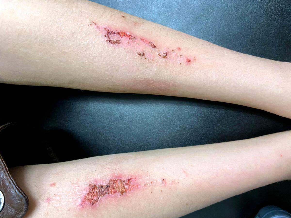 Kids put into isolated circumstances in locked institutions with psychiatric conditions can continue to harm themselves. In this photo taken by an adult visitor, a child’s arm wounds have become infected at a psychiatric center North Carolina sends kids into. The facility has battled issues with staph infections due to building cleanliness problems.
