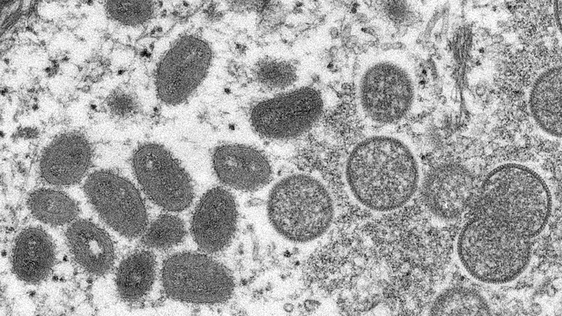 ‘Too early to tell’ if monkeypox can be contained in U.S., health officials say