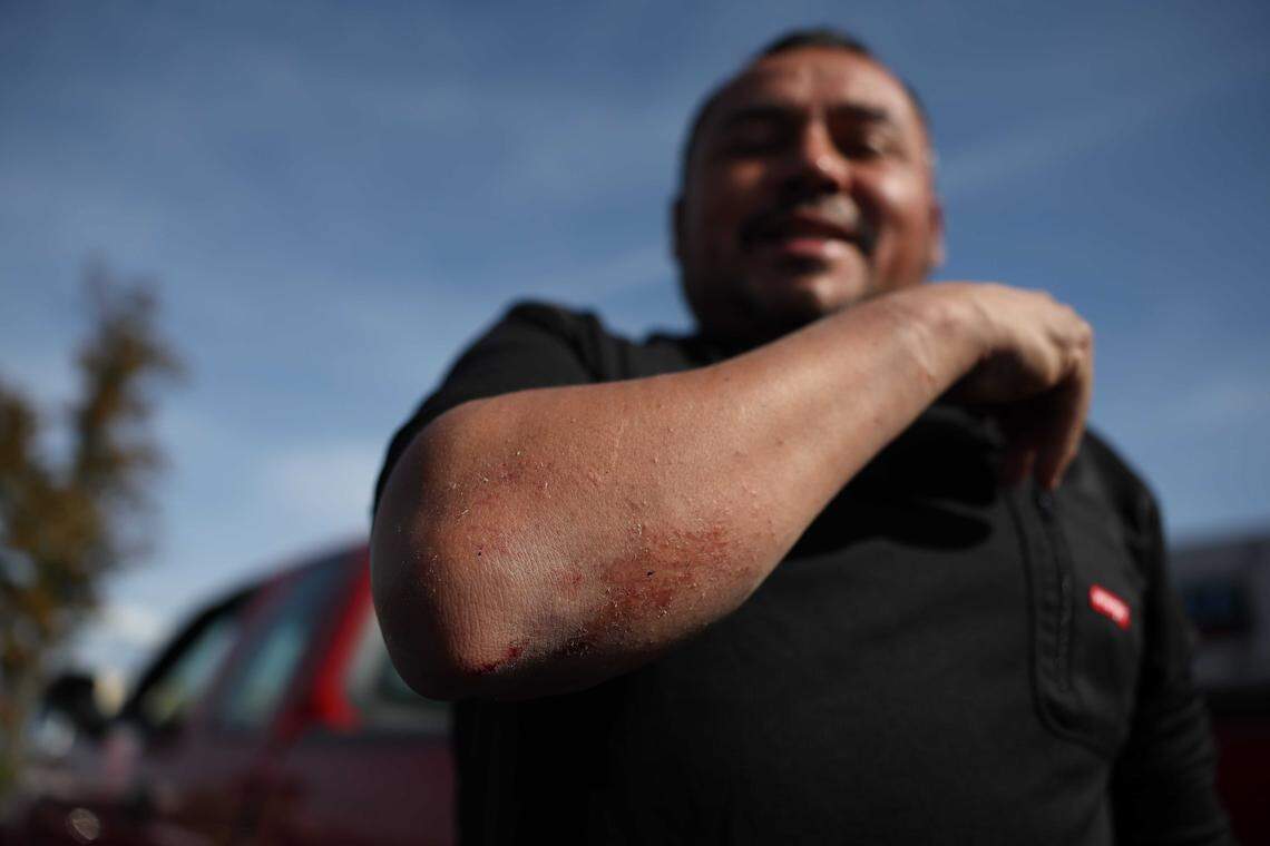 Willy Aceituno shows his scars from a confrontation with U.S. Border Patrol agents on Saturday morning at Pollo Campero restaurant near the intersection of South Boulevard and Archdale Drive. He said agents attempted to arrest him twice and smashed his car window when he tried to leave.