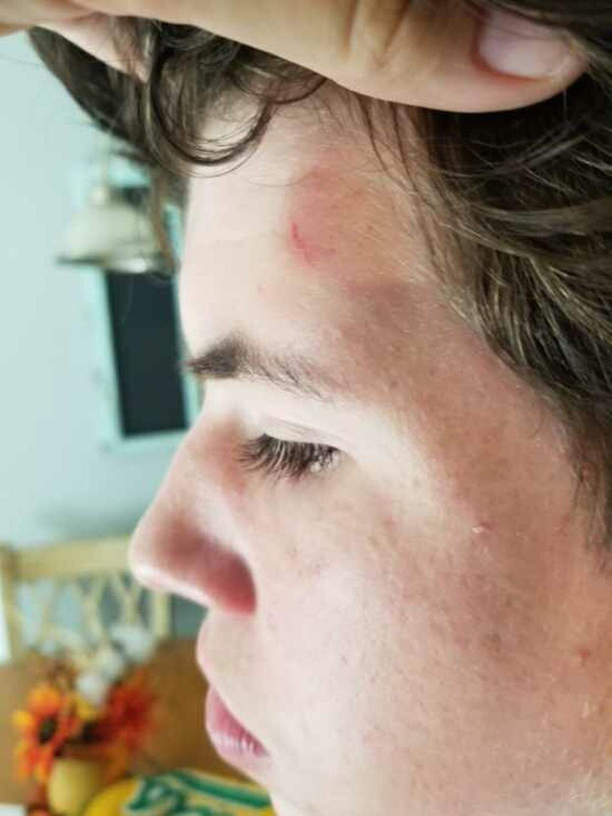 Ean Hughes suffered a concussion due to blows to his head during the attack.
