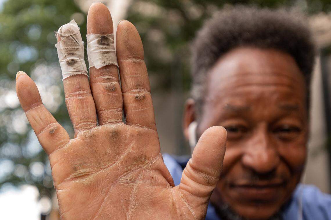 Conga drummer Joel Burks, 58, shows his right hand to the camera Tuesday, June 7, 2022 in uptown Charlotte, N.C. On occasion, Burks says, his skin will split from long days on the congas.