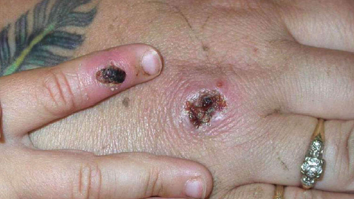 Monkeypox case reported in county near Charlotte, the 13th in NC