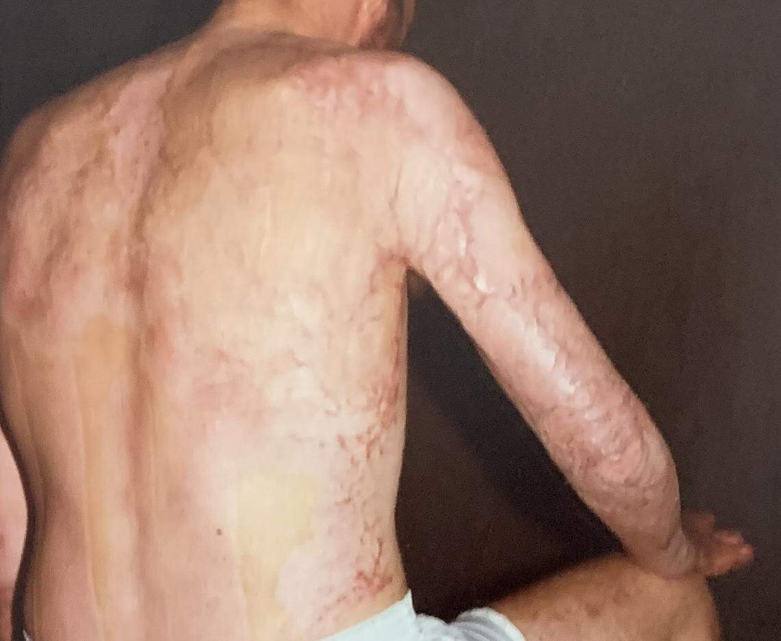 Flight 212 passenger Richard Arnold’s scarring was documented in a photograph that was presented as evidence in the trial against Eastern Air Lines.