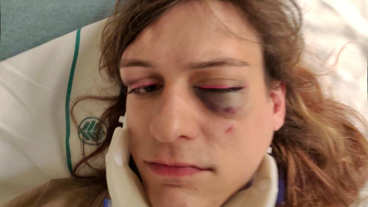 Lynette Matusik after her run-in with a bouncer who was working at a NoDa pub.