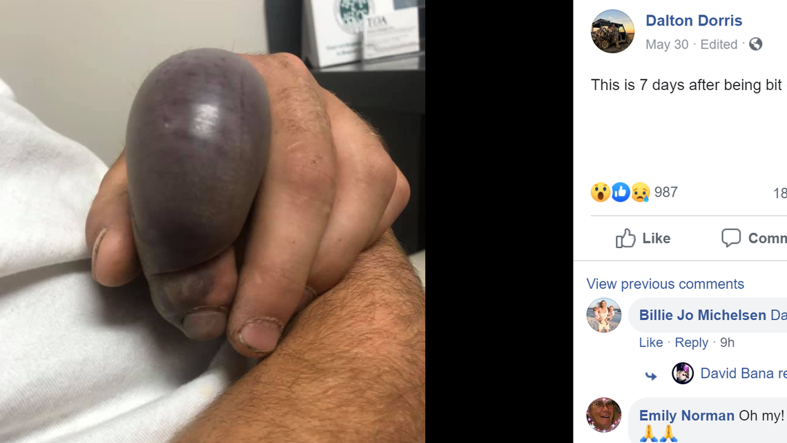 This is what Austin McGee’s index finger looked like seven days after he was bitten by a “baby rattlesnake,” according to Dalton Dorris.