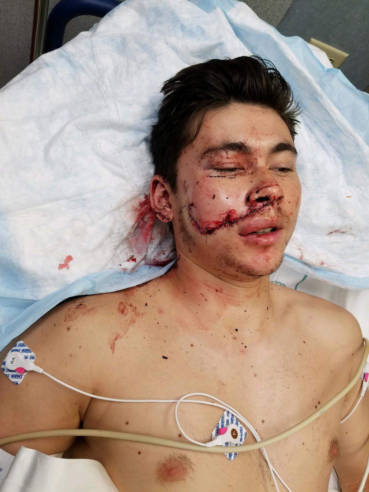 Robert Lyew shortly after having 22 stitches sewn into his face to repair the laceration he sustained in the crash.