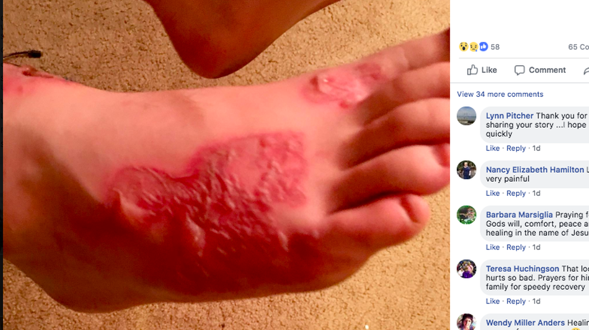 A Memphis, Tennessee, teenager’s family says the boy was diagnosed with a parasitic hookworm infection after being buried in the sand during a mission trip at Pompano Beach in Florida. He is taking anti-parasite drugs.