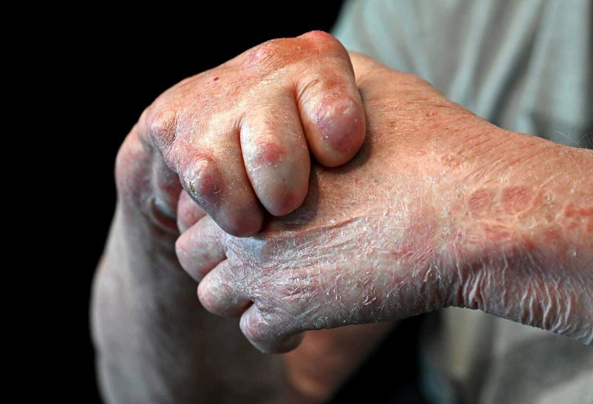 Eastern Flight 212 survivor Richard Arnold, photographed in April 2024, sustained serious burns in the crash that caused significant deformation and scarring to his hands.