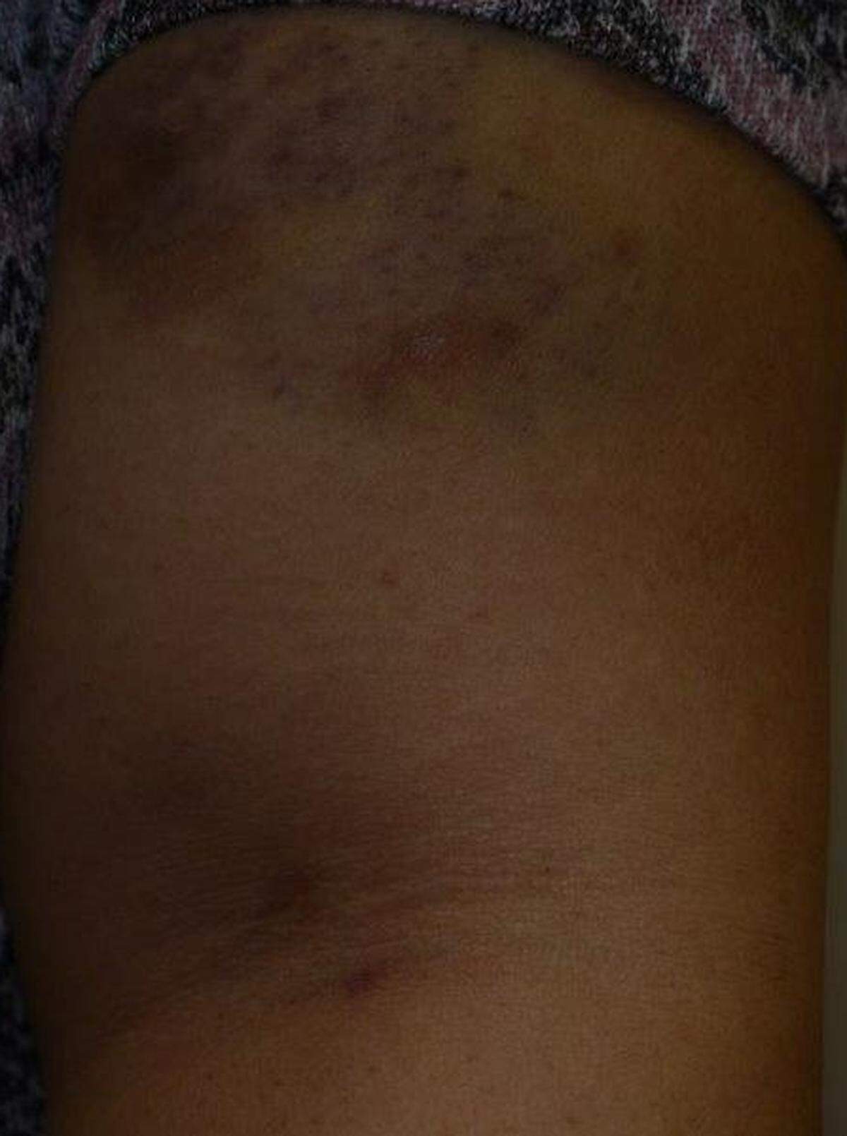 This Davidson police photograph shows the arm of a trafficking victim after she says she was assaulted in June 2018 by Davidson salon owner Thuy Tien Luong.