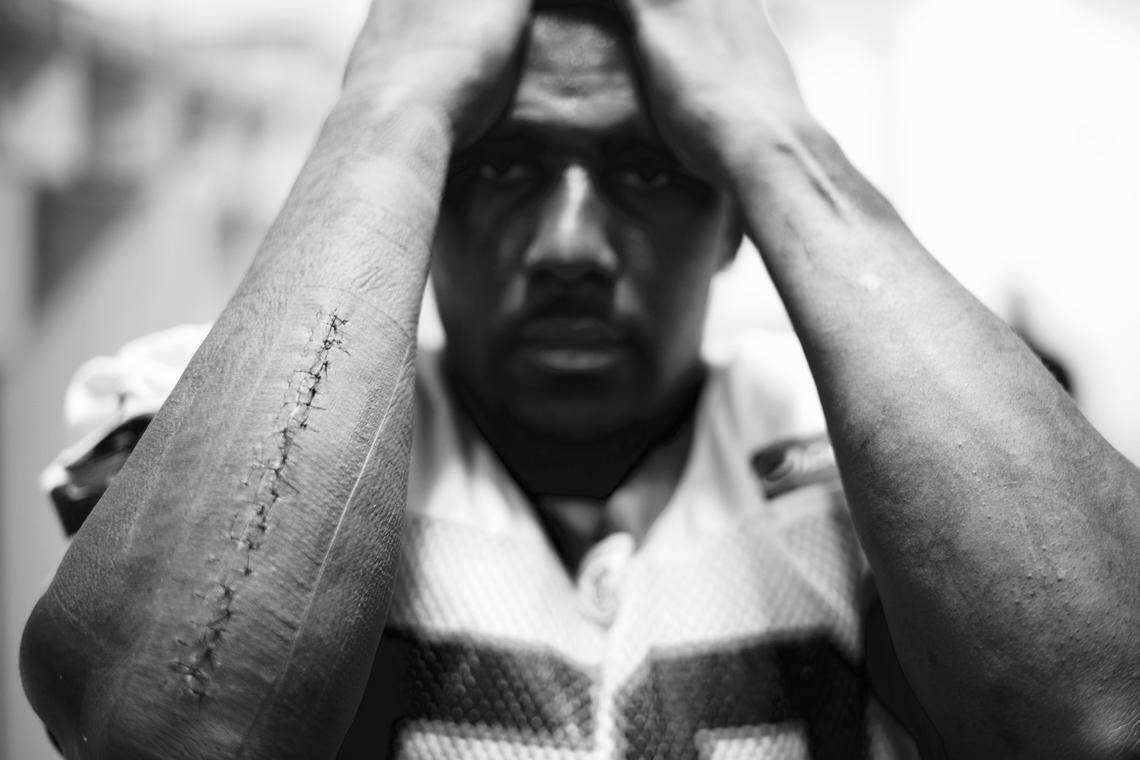 A photograph taken by Carolina Panthers center Ryan Kalil shortly before Super Bowl 50 shows the stitching on the right forearm of linebacker Thomas Davis. Davis had surgery 13 days before the Super Bowl 50 to repair his broken arm, then played in the game.