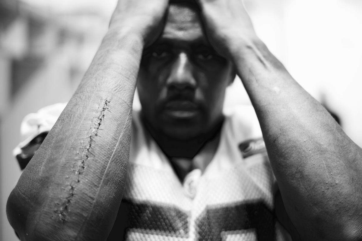 A photograph taken by Carolina Panthers center Ryan Kalil shortly before Super Bowl 50 shows the stitching on the right forearm of linebacker Thomas Davis. Davis had surgery 13 days before the Super Bowl 50 to repair his broken arm, then played in the game.