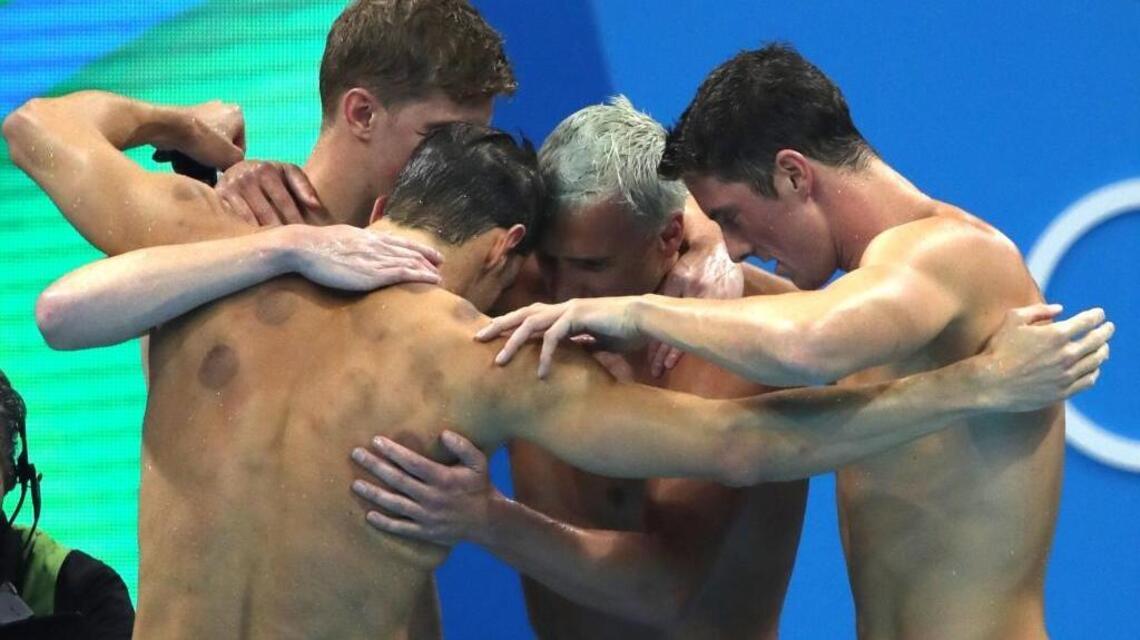 Cupping, used by Michael Phelps, provides pain relief and eases muscle tension, area acupuncturist says