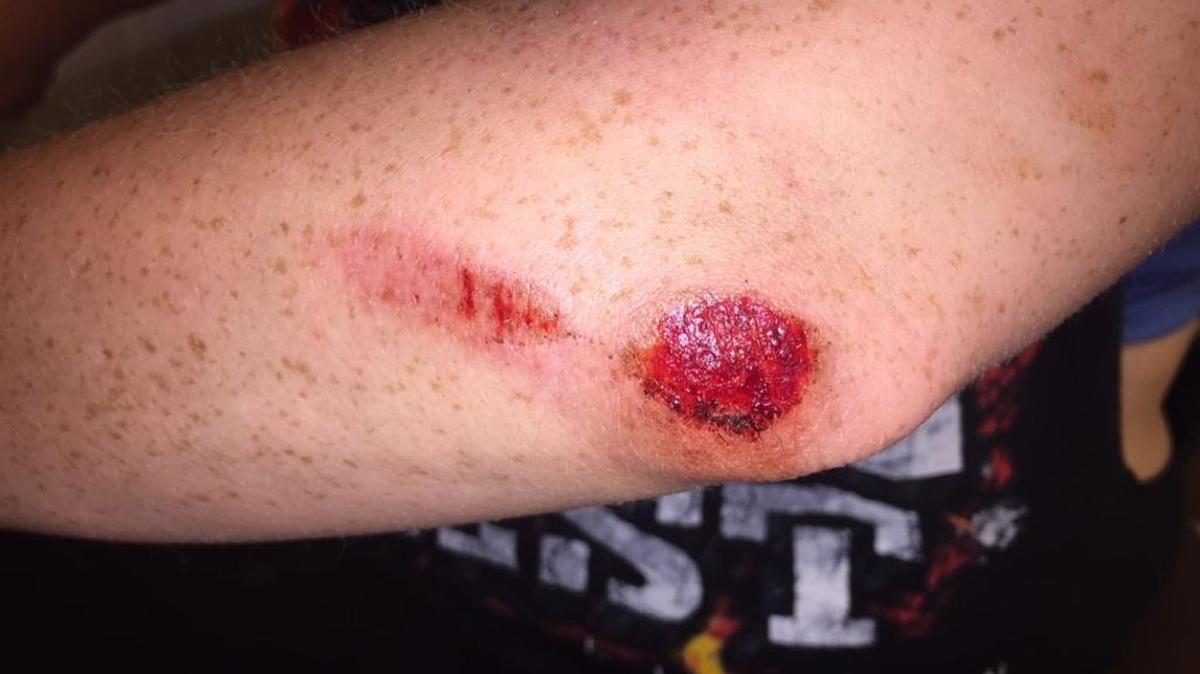 Besides this abrasion on her elbow, the woman who reported being attacked because she’s gay also has a busted lip and a cut behind her ear. She said she was kicked in the ribs after being slammed to the ground. She provided this photo.