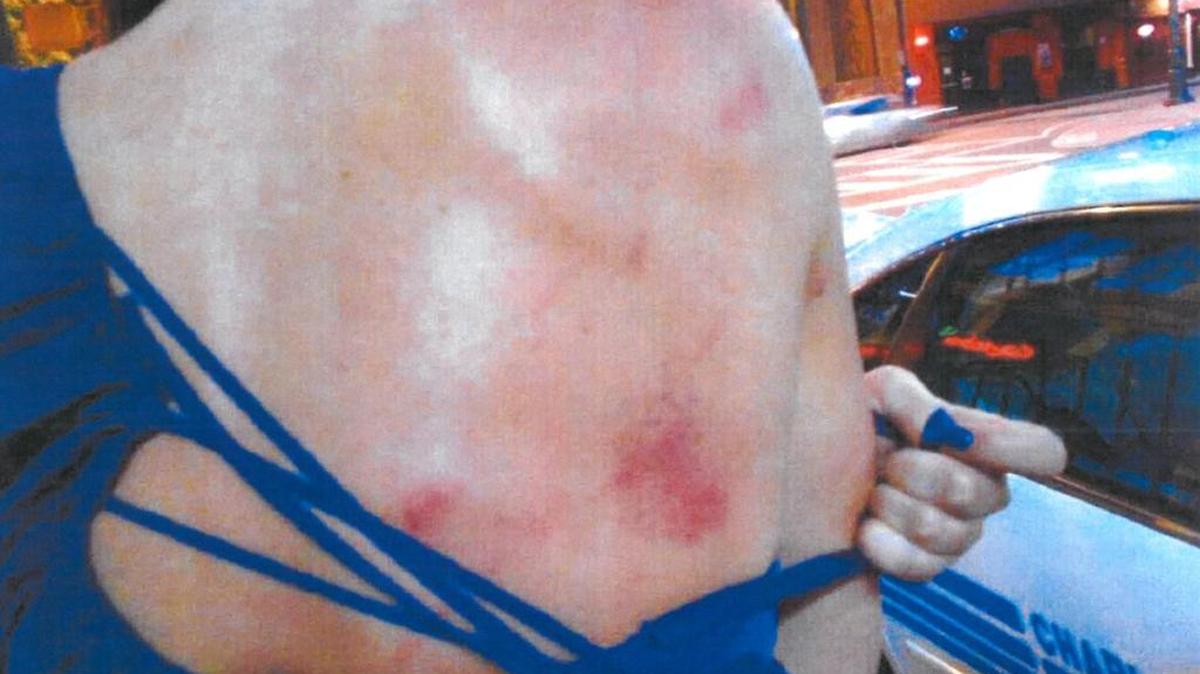 A police photo shot outside of Greg Hardy’s condo in May 2014 shows bruising on Nicole Holder’s back.
