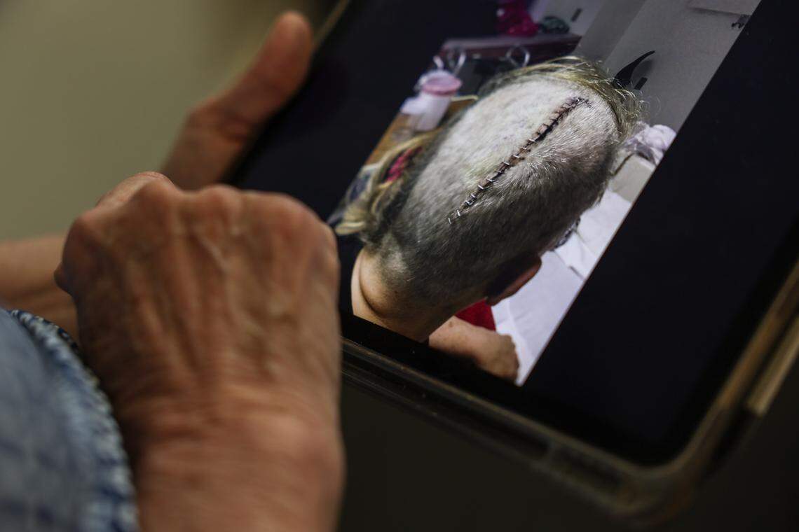 Sylvia Baird shows a photo of her brain surgery scar, taken after she had a tumor removed in 2016. It’s one of many serious health problems she’s suffered since the 2010 fume event.