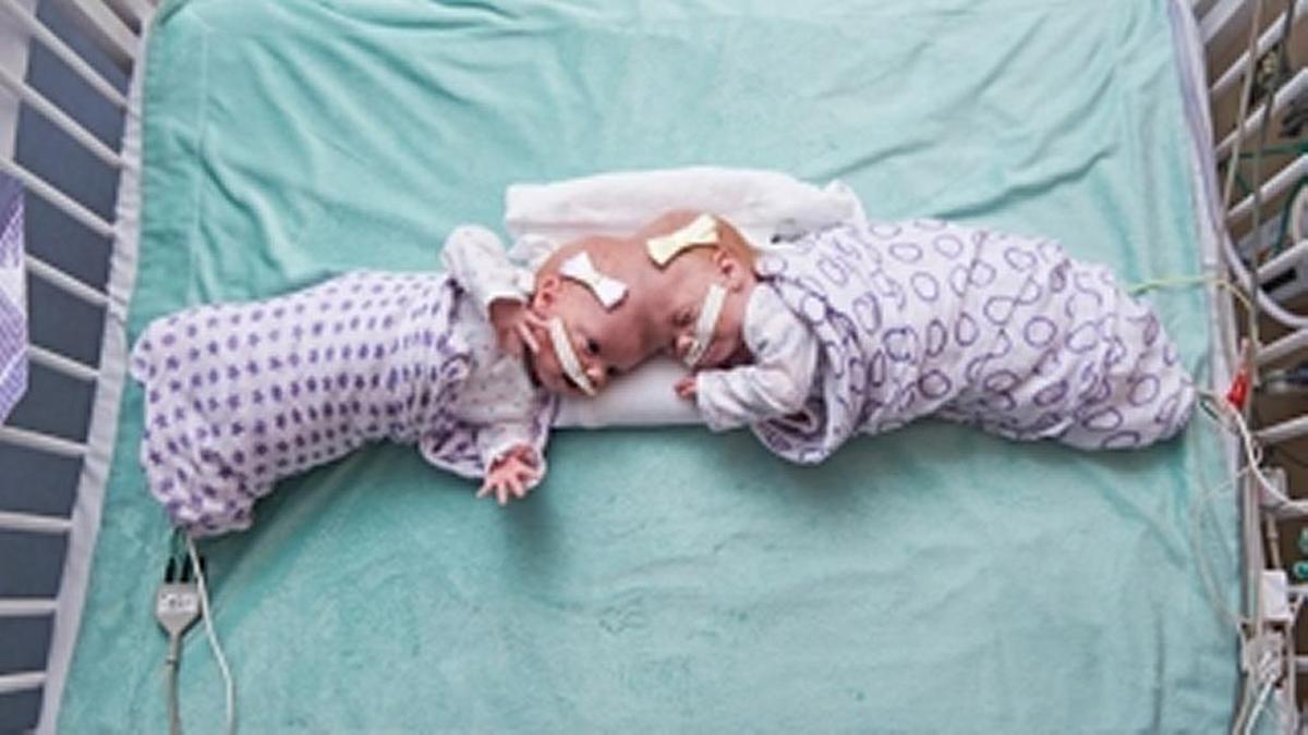 Erin and Abby Delaney before they were separated.