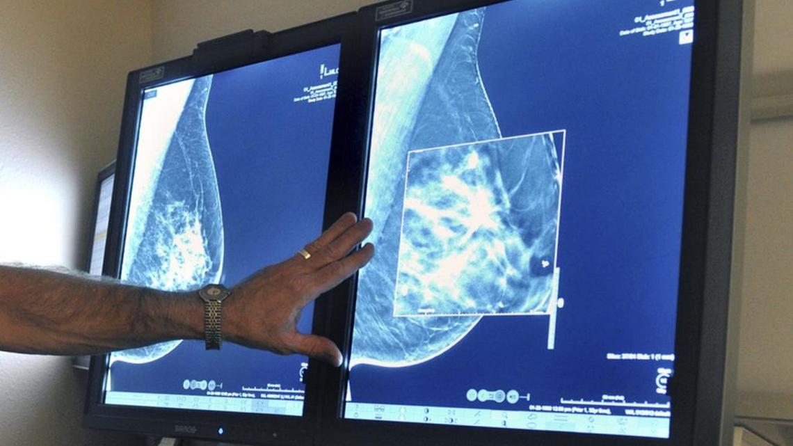 A decades-old debate rears its head again: Is earlier breast cancer screening better?