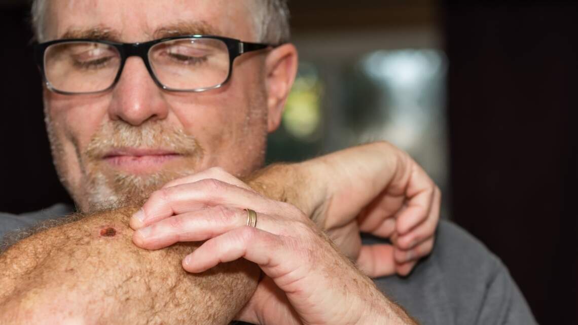 This Procedure Has the Highest Cure Rate of Any Skin Cancer Treatment