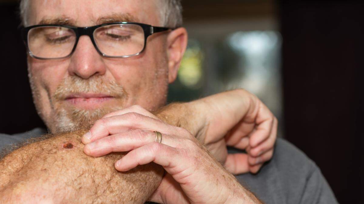 This Procedure Has the Highest Cure Rate of Any Skin Cancer Treatment Featured Image